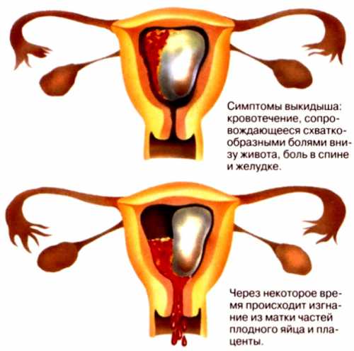 Не стоит смотреть на подруг, у которых все завершилось благополучно, несмотря на постоянные менструации в период вынашивания малыша, случаи могут быть различными, необходимо проконсультироваться с врачом