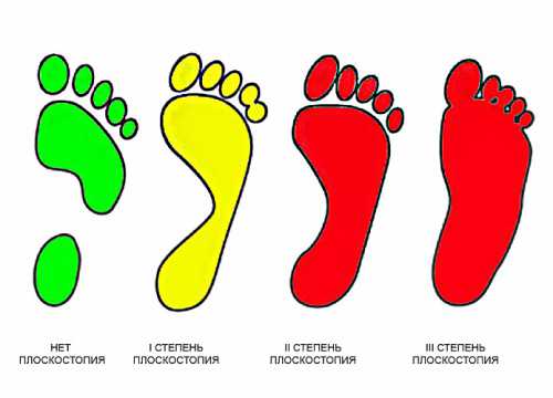 Плоскостопие у детей 1, 2, 3 степени