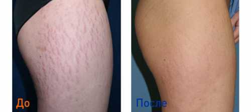 И тогда на помощь женщинам приходит кардинальный и действительно эффективный метод лазерная шлифовка растяжек и рубцов