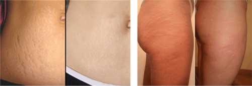 Те, кто намерен сбросить вес или планирует после беременности и родов вернуться к своим прежним параметрам, наверняка ориентируется в мазях и кремах, предупреждающих появление рубцов или сокращающих уже имеющиеся растяжки