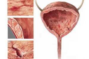 Расплавленный озокерит или парафин наносят на тканевую салфетку и прикладывают в область поясницы