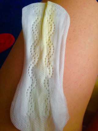 Амниоцентез в полость матки через прокол на животе вводится безопасный краситель