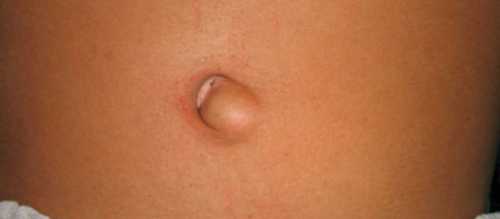 При его использовании операция выполняется под наркозом, с помощью видеосредств