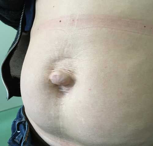 Пупочная грыжа у мужчин: симптомы, причины, это