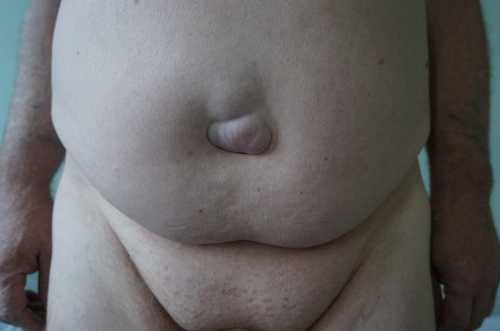 УЗИ брюшины и грыжевого мешка дает возможность определить, что находится внутри, выяснить количество кишечных петель и как они располагаютсяирригос копия выполняется с помощью введения в анальное отверстие специального раствора, который хорошо просматривается в рентгеновских лучах, после чего понятны размеры и содержимое мешка