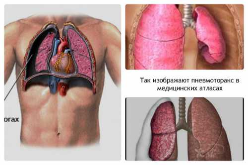 Послойное наложение на рану ватномар левых дисков, герметичной упаковки стерильной стороной к ране и полностью закрывающей наложенные на рану подушечки, тугое бинтование