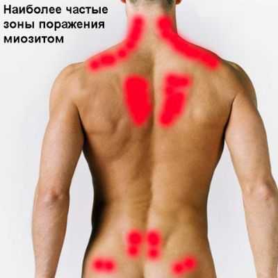 Хондроз ранний этап продолжительного дегенеративнодистрофичес кого процесса