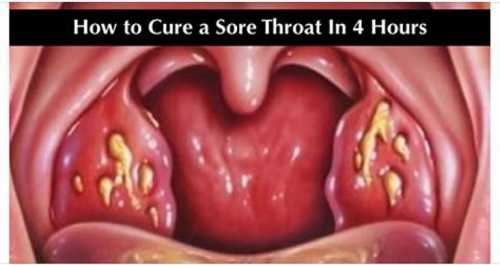 Лечение фарингита народными средствами