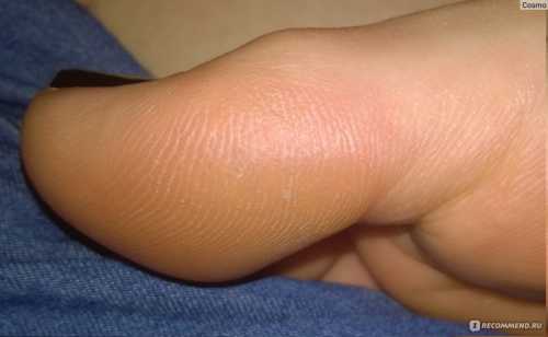 После дайте траве настояться часа и используйте для изготовления марлевых повязок на пятки