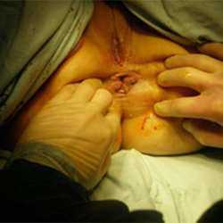 Геморрой во время беременности