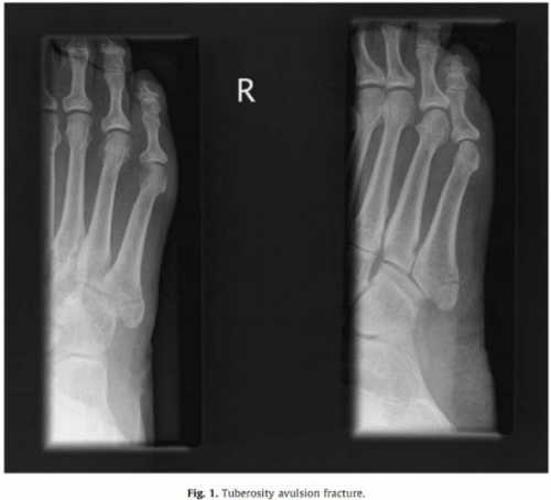 Лучше постепенно разрабатывать ногу, чем получить постоянную хромоту