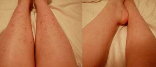 Как избавиться от волос на ногах, что поможет и