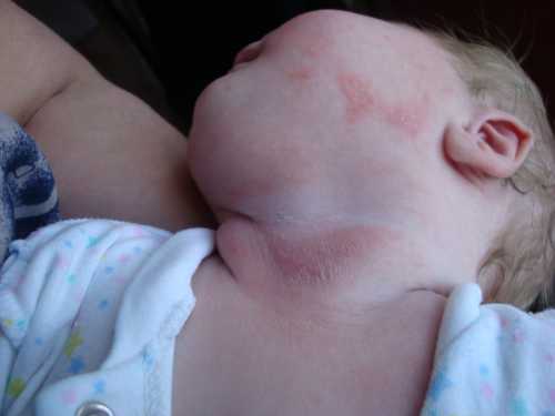 Традиционный вариант течения патологии один воспаленный очаг большее количество зон наблюдается реже