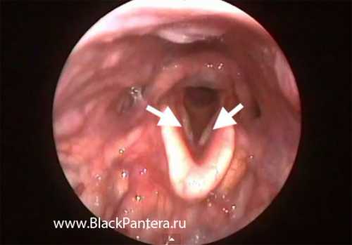 В гортани при ларингос копии можно обнаружить кровоточащие участки