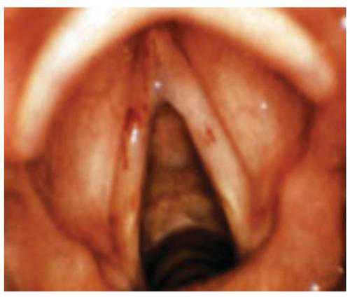 Возникает в том случае, если вовремя не оказали необходимого лечения инфильтративного ларингита