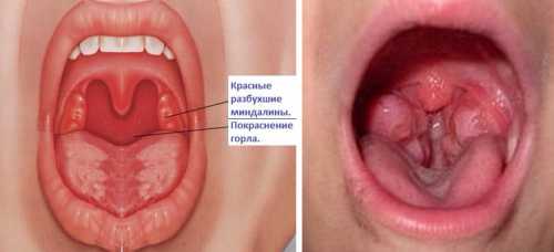 Лечить ребенка самостоятельно нельзя, но оказать симптоматическое лечение до прихода врача нужно