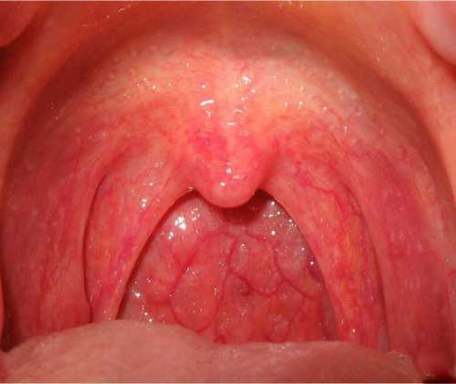 Помните, чем больше градусы тела, тем выше риск