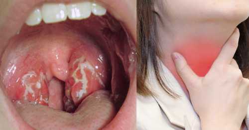 Воспаление миндалин: симптомы, первая помощь