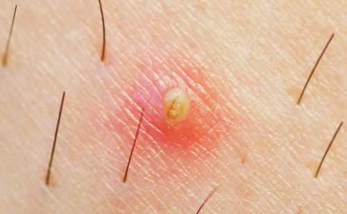 Поскольку проблему лучше предотвратить, чем потом ее решать, сделав депиляцию, нанесите на кожу крем от врастания волос после эпиляции