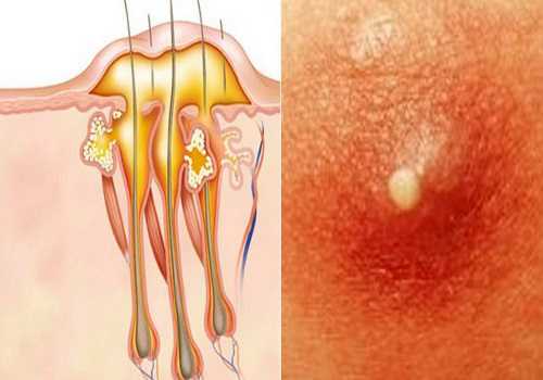 Как лечить фурункул в домашних условиях, что