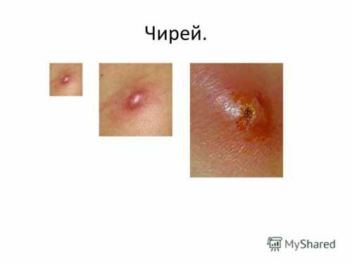 Существует множество проверенных способов терапии фурункулов в домашних условиях