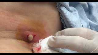 На стадии инфильтрации период образования нарыва, чаще всего обходятся консервативным лечением