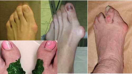 Комплекс из 5 мер, чтобы избавиться от шишки на стопе