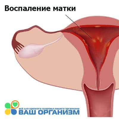 В этих условиях патогенные микроорганизмы беспрепятственно проникают из внешней среды и активно размножаются на раневой поверхности матки внутрима точными контрацептивами