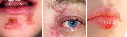 К сему можно добавить и от рекламы тоже , Те же антивирусные препараты, как правило, помогают только при первом появлении зуда