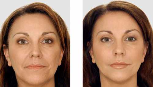 Подушечками пальцев выполняется горизонтальных поглаживающих движений по направлению от центра лба к вискам