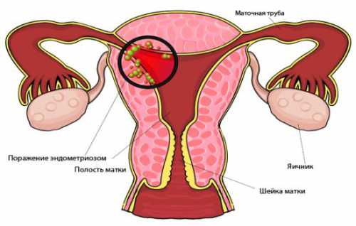 Если у вас диагностировали эту патологию, и вы не можете, но хотите забеременеть, то чем раньше вы обратитесь к врачу, тем лучше