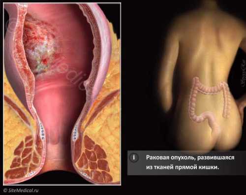 Гормональные колебания особенно негативно воздействуют на сердечно сосудистую систему