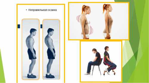 Медикаментозная терапия в отношении искривления осанки используется в качестве вспомогательной терапии