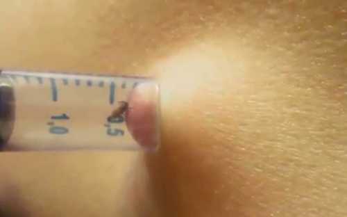 Как вытянуть клеща: подробная инструкция