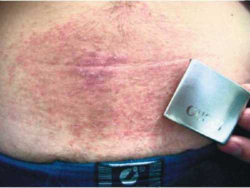 Аллергия на металл