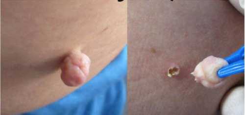 К чему приводят попытки самостоятельно свести бородавки и папилломы