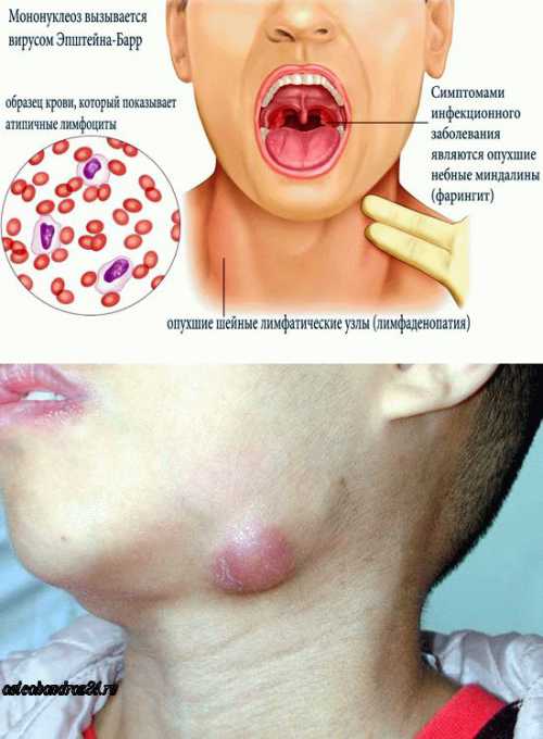 Мононуклеоз у детей – симптомы и лечение Вирус Эпштейна