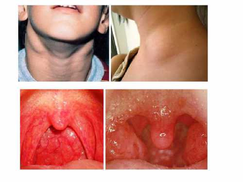 Заболевание коварно тем, что инфекция быстро распространяется по организму