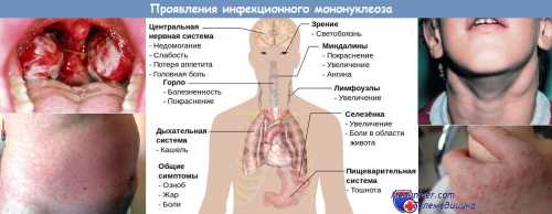 Ответ на вопрос чем лечить мононуклеоз у ребёнка зависит от возбудителя болезни