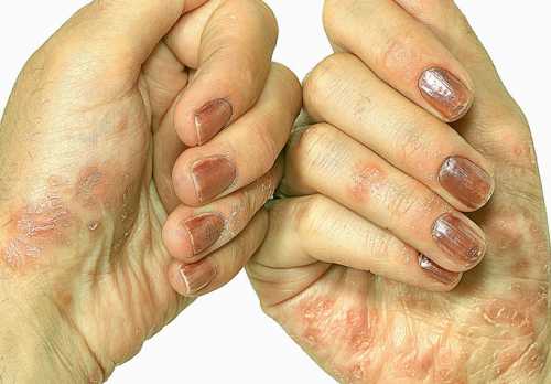 Экзема на руках