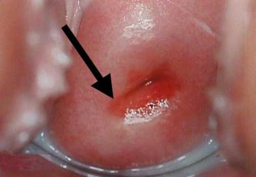 Цервицит шейки матки