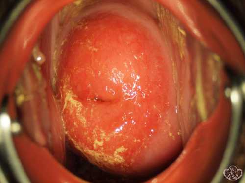 При лечении цервицита свечами нужно правильно подбирать тип препаратов, чтобы они боролись с возбудителем патологии